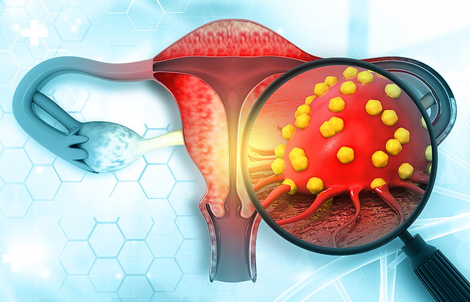 cáncer cervicouterino en México