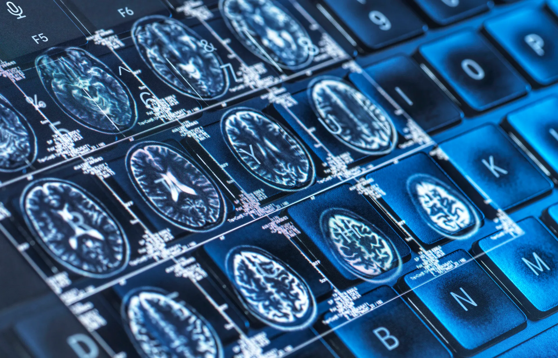 avance contra el Alzheimer