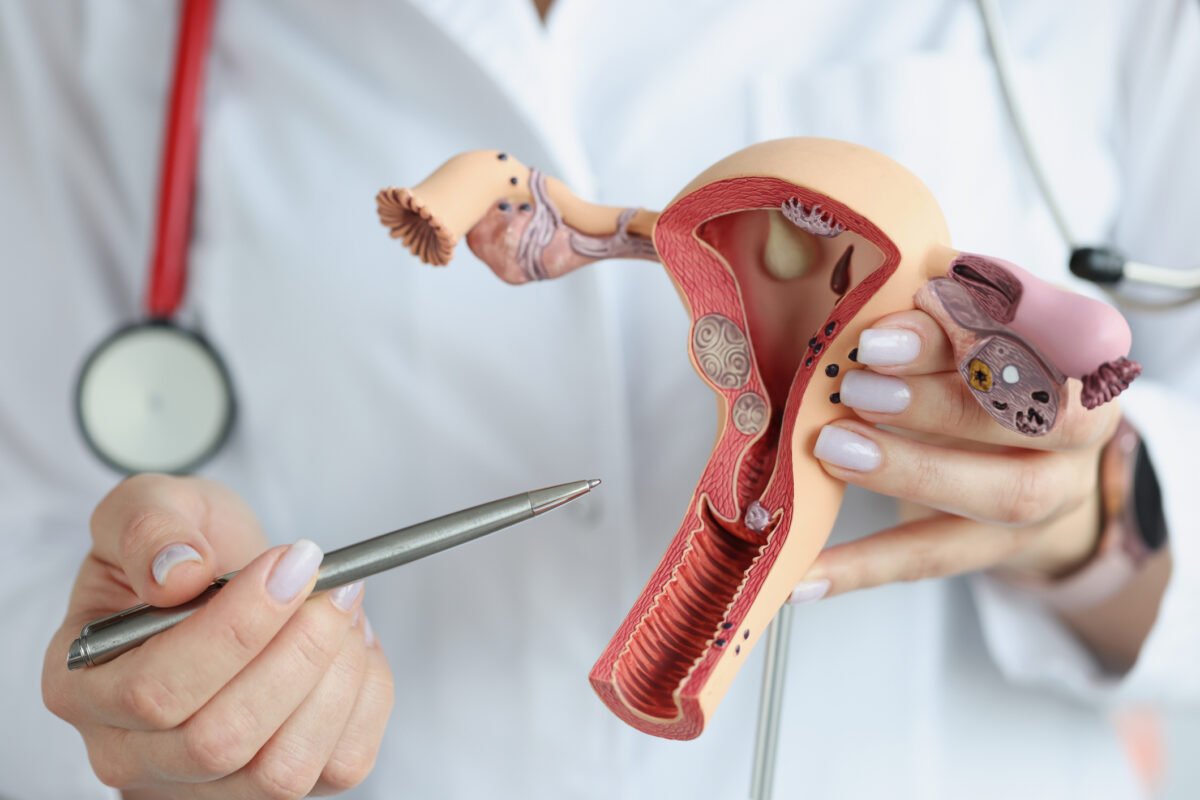 cáncer de ovario