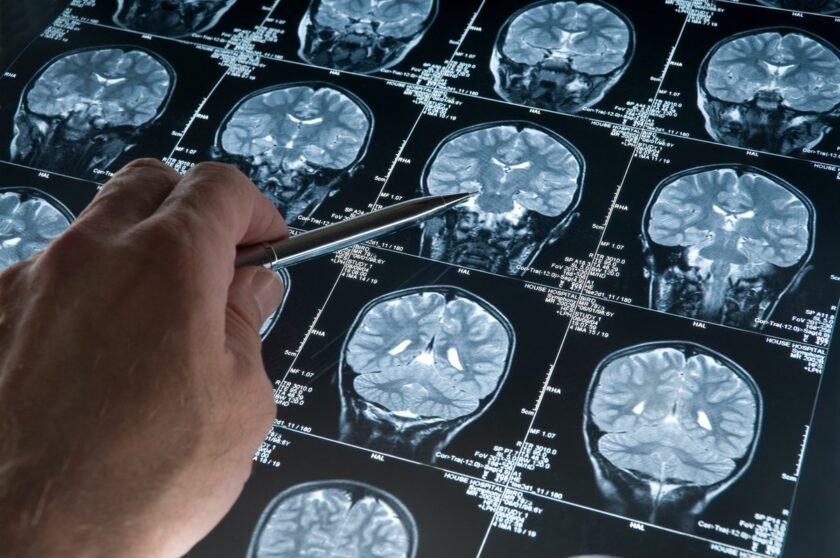 proteína SORLA daño cerebral